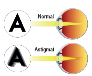 Astigmat göz yapısı