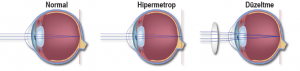 Hipermetrop göz yapısı ve düzeltilmesi