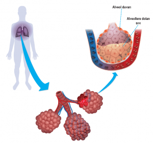 Alveollerde iltihaplanma ve zatürre oluşumu