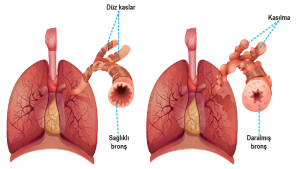 Astıma bağlı olarak akciğerde solunum yollarında daralma