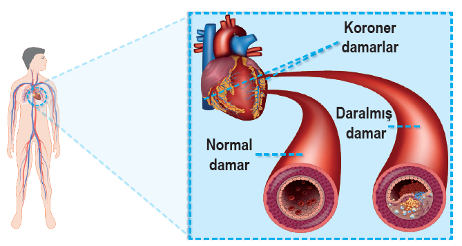 varisli damarlar yüksek tansiyon diyabet mevcudiyet sağlık sağlıklı kalp